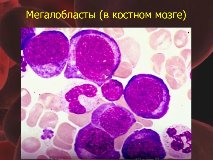 Мегалобласты (в костном мозге)