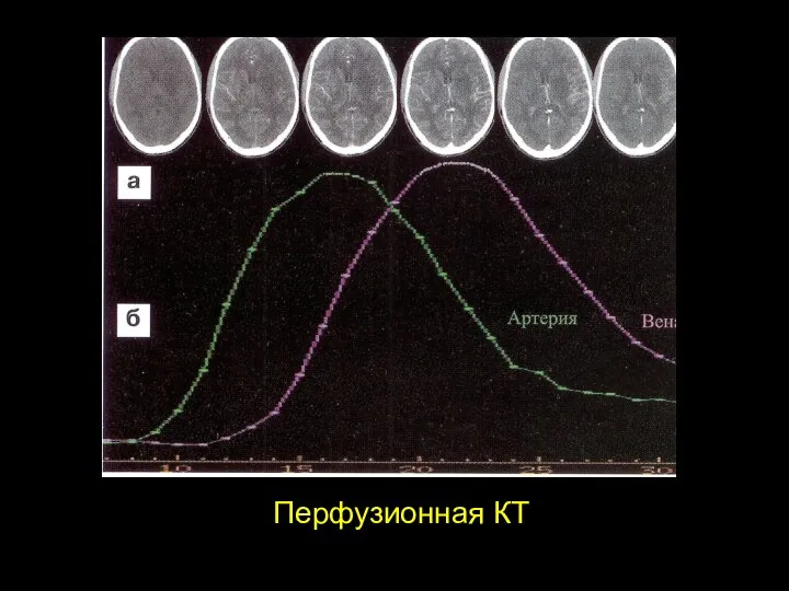 Перфузионная КТ