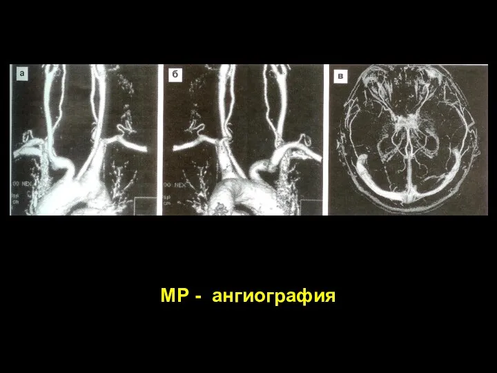 МР - ангиография