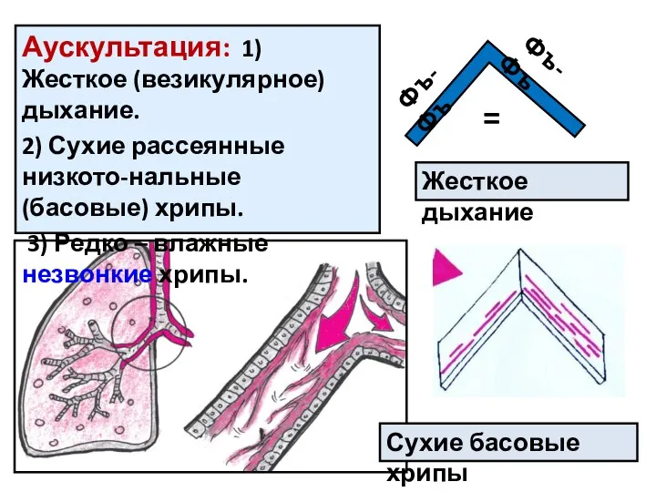 Фъ-Фъ Фъ-Фъ Жесткое дыхание = Сухие басовые хрипы Аускультация: 1) Жесткое