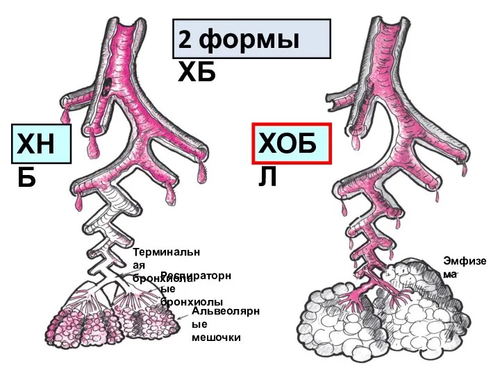 Терминальная бронхиола Респираторные бронхиолы Альвеолярные мешочки Эмфизема 2 формы ХБ ХНБ ХОБЛ