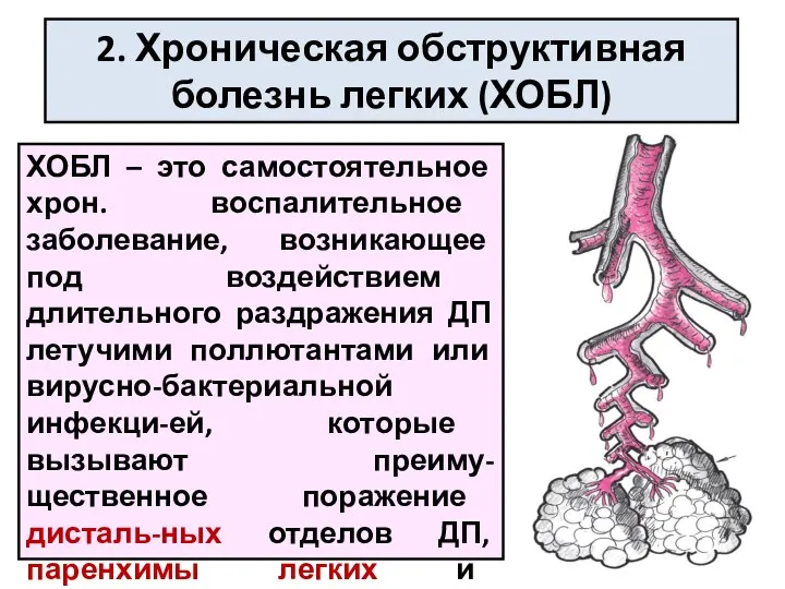 2. Хроническая обструктивная болезнь легких (ХОБЛ) ХОБЛ – это самостоятельное хрон.