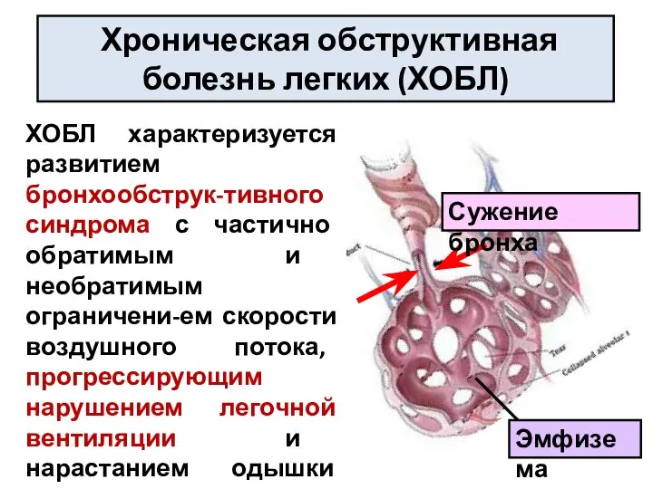 ХОБЛ характеризуется развитием бронхообструк-тивного синдрома с частично обратимым и необратимым ограничени-ем