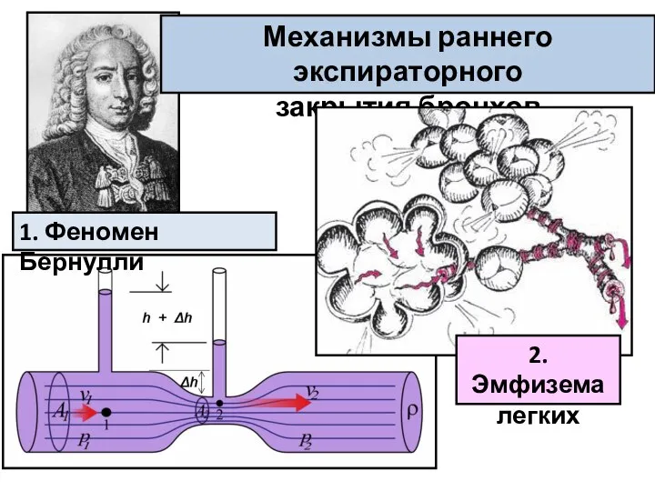 Механизмы раннего экспираторного закрытия бронхов 1. Феномен Бернулли 2. Эмфизема легких