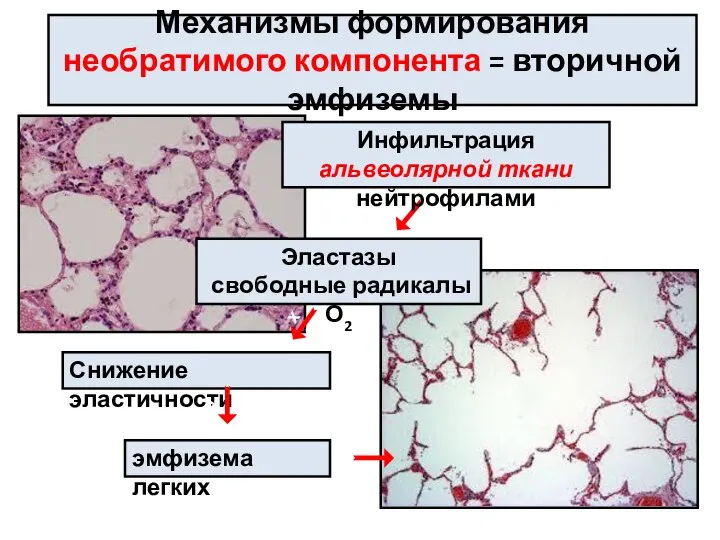 Механизмы формирования необратимого компонента = вторичной эмфиземы е х Инфильтрация альвеолярной