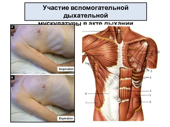 Участие вспомогательной дыхательной мускулатуры в акте дыхании