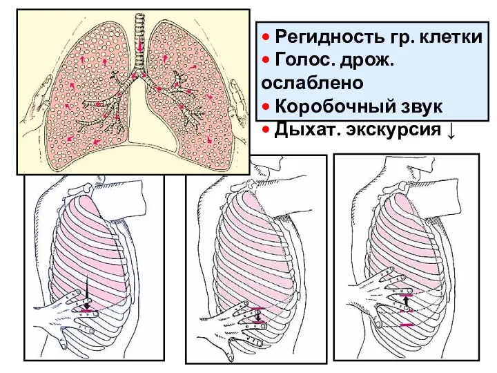 • Регидность гр. клетки • Голос. дрож. ослаблено • Коробочный звук • Дыхат. экскурсия ↓