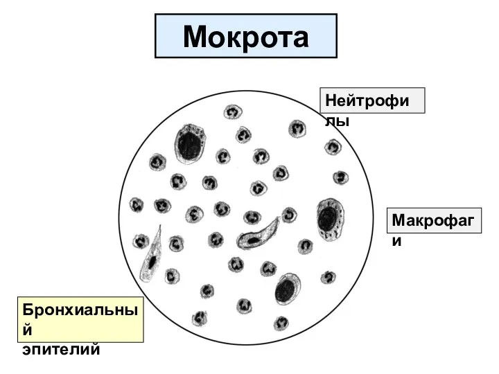 Мокрота Нейтрофилы Макрофаги Бронхиальный эпителий