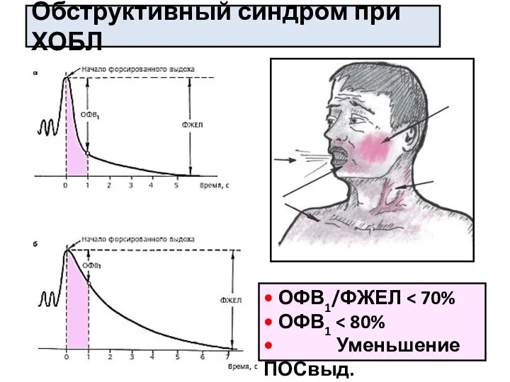 Обструктивный синдром при ХОБЛ • ОФВ1/ФЖЕЛ • ОФВ1 • Уменьшение ПОСвыд.