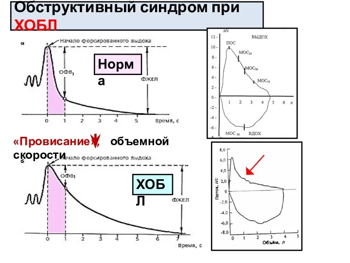 Обструктивный синдром при ХОБЛ «Провисание», объемной скорости Норма ХОБЛ