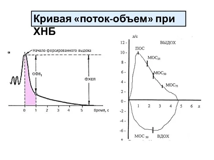 Кривая «поток-объем» при ХНБ