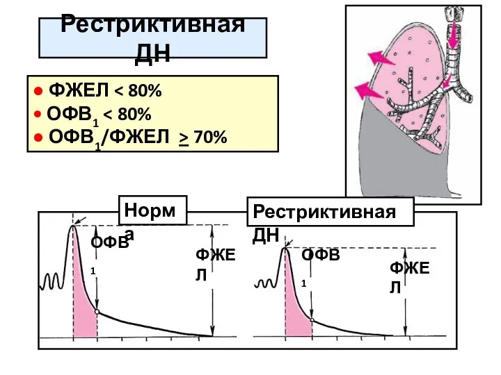 Рестриктивная ДН ОФВ1 ОФВ1 ФЖЕЛ ФЖЕЛ ● ФЖЕЛ • ОФВ1 ●