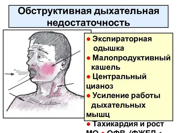 Обструктивная дыхательная недостаточность ● Экспираторная одышка ● Малопродуктивный кашель ● Центральный