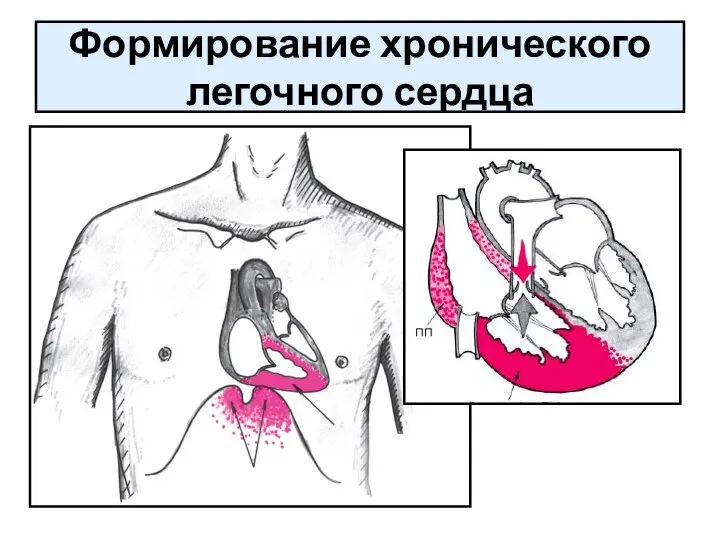 Формирование хронического легочного сердца