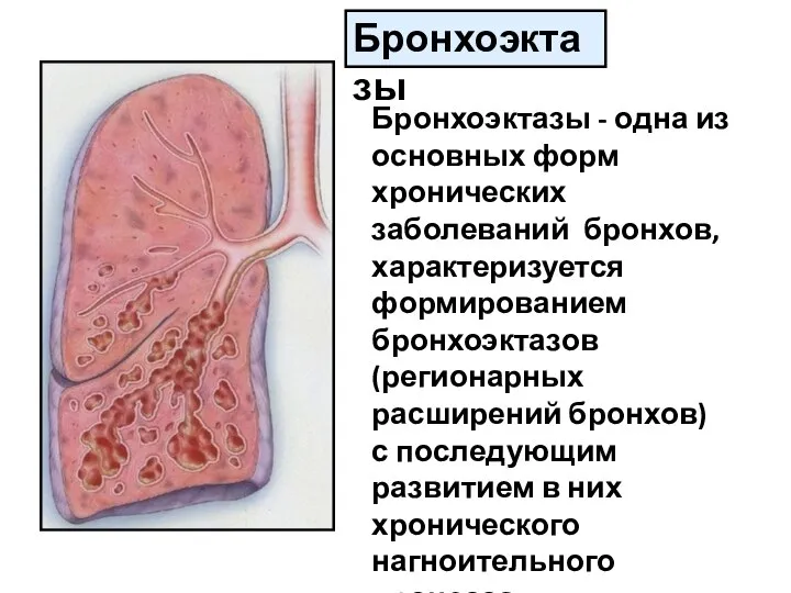 Бронхоэктазы Бронхоэктазы - одна из основных форм хронических заболеваний бронхов, характеризуется