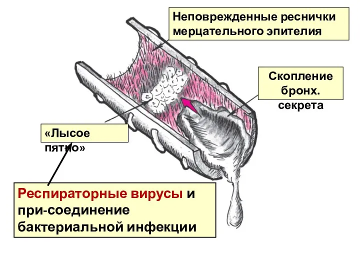 Неповрежденные реснички мерцательного эпителия «Лысое пятно» Скопление бронх.секрета Респираторные вирусы и при-соединение бактериальной инфекции