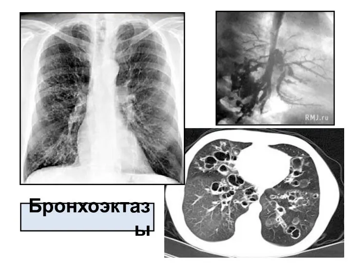 Бронхоэктазы