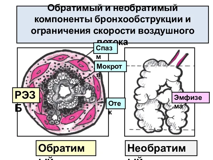 Обратимый и необратимый компоненты бронхообструкции и ограничения скорости воздушного потока Обратимый