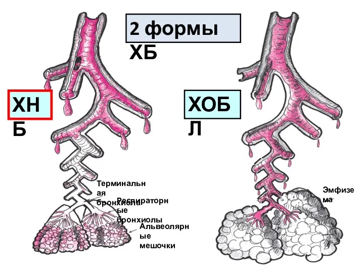 Терминальная бронхиола Респираторные бронхиолы Альвеолярные мешочки Эмфизема 2 формы ХБ ХНБ ХОБЛ