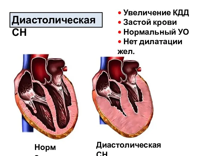 Диастолическая СН • Увеличение КДД • Застой крови • Нормальный УО