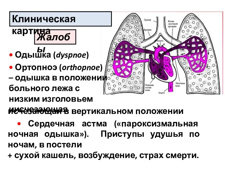 Жалобы Клиническая картина исчезающая в вертикальном положении • Сердечная астма («пароксизмальная