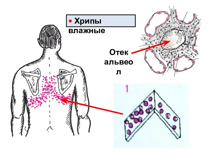 Отек альвеол • Хрипы влажные