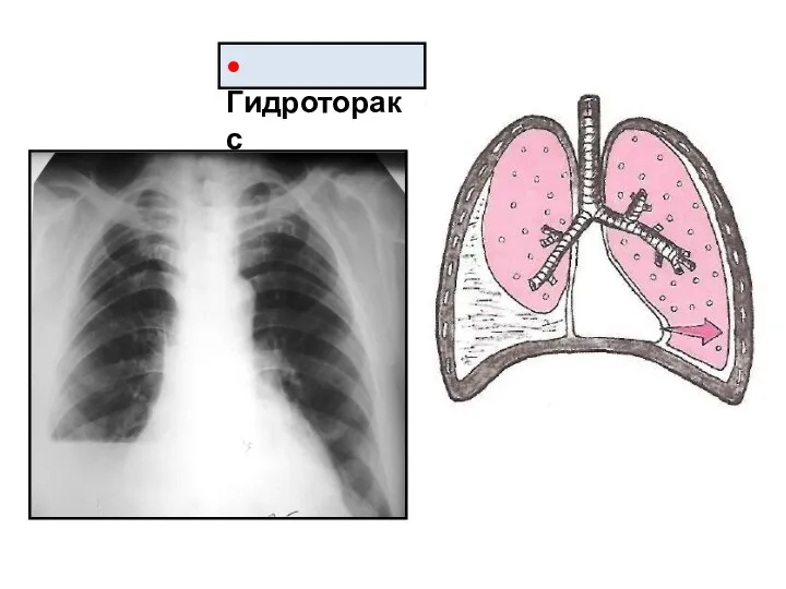 • Гидроторакс