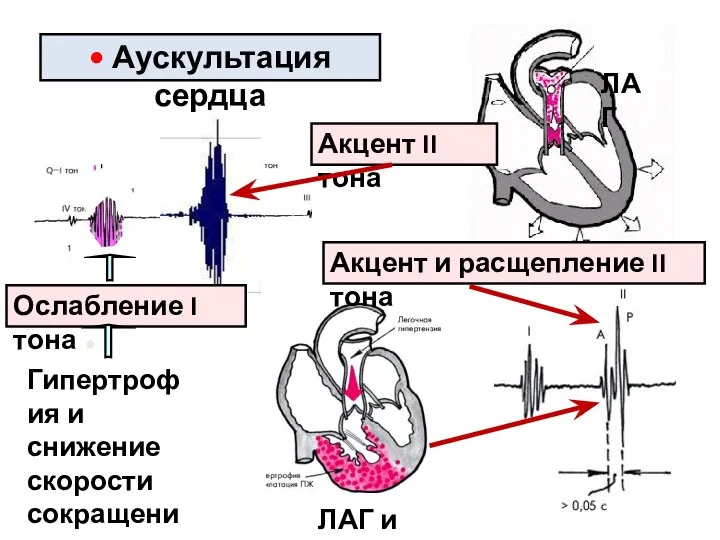 ● Ослабление I тона • Аускультация сердца Гипертрофия и снижение скорости