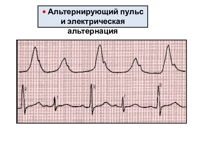 • Альтернирующий пульс и электрическая альтернация