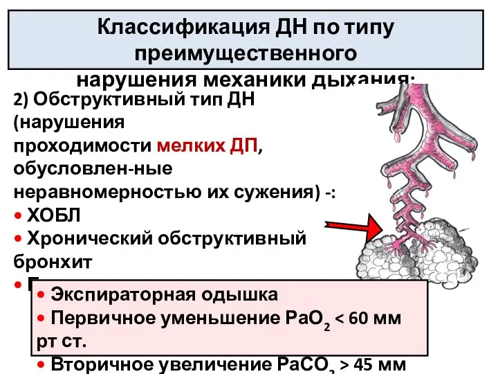 2) Обструктивный тип ДН (нарушения проходимости мелких ДП, обусловлен-ные неравномерностью их