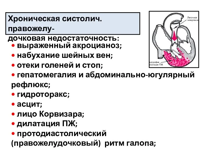 Хроническая систолич. правожелу- дочковая недостаточность: • выраженный акроцианоз; • набухание шейных