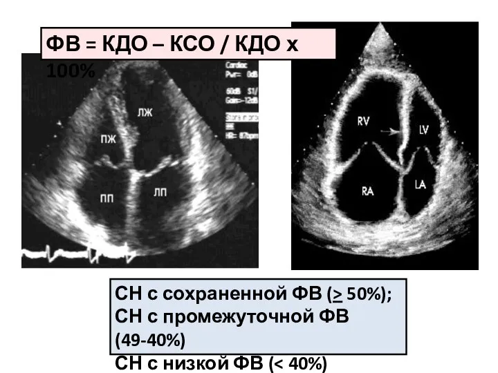 СН с сохраненной ФВ (> 50%); СН с промежуточной ФВ (49-40%)