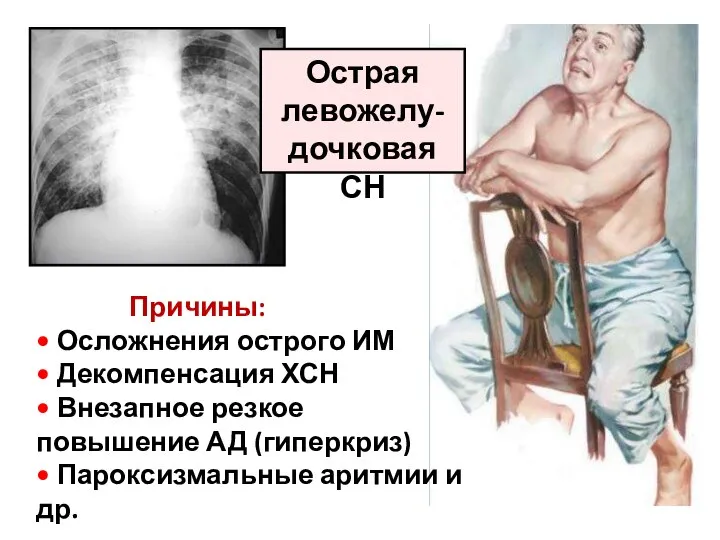 Острая левожелу-дочковая СН Причины: • Осложнения острого ИМ • Декомпенсация ХСН