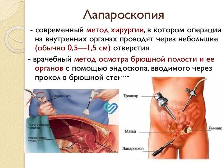 Лапароскопия - современный метод хирургии, в котором операции на внутренних органах