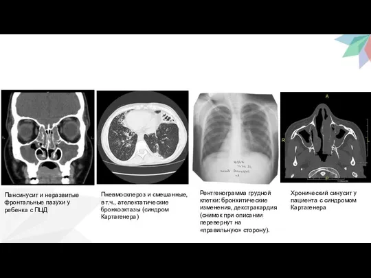 Пансинусит и неразвитые фронтальные пазухи у ребенка с ПЦД Пневмосклероз и