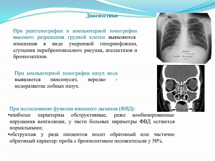 Диагностика При рентгенографии и компьютерной томографии высокого разрешения грудной клетки выявляются