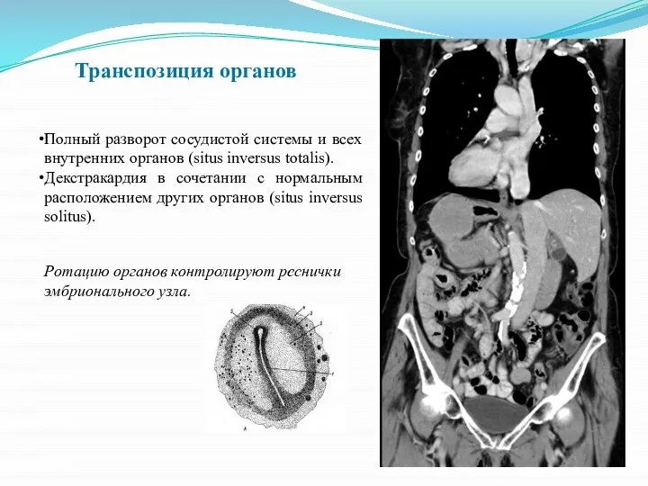 Транспозиция органов Полный разворот сосудистой системы и всех внутренних органов (situs