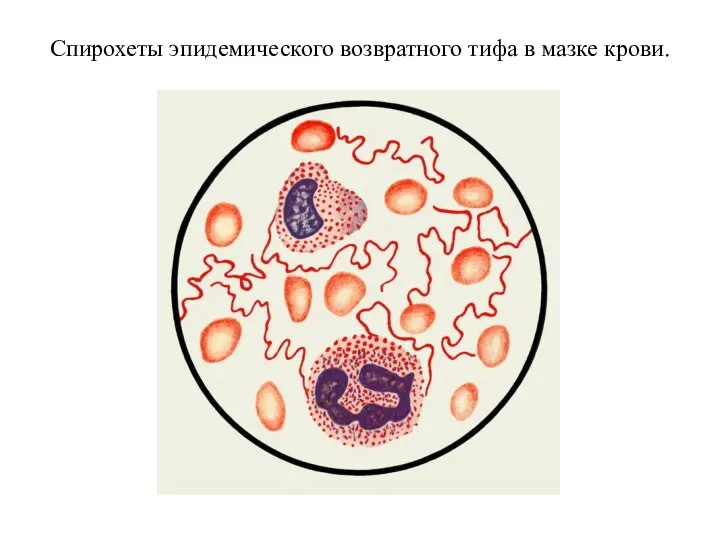 Спирохеты эпидемического возвратного тифа в мазке крови.