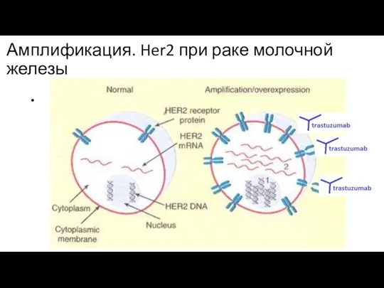 Амплификация. Her2 при раке молочной железы