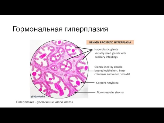 Гормональная гиперплазия Гиперплазия – увеличение числа клеток.