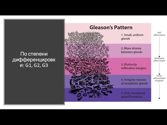 По степени дифференцировки: G1, G2, G3