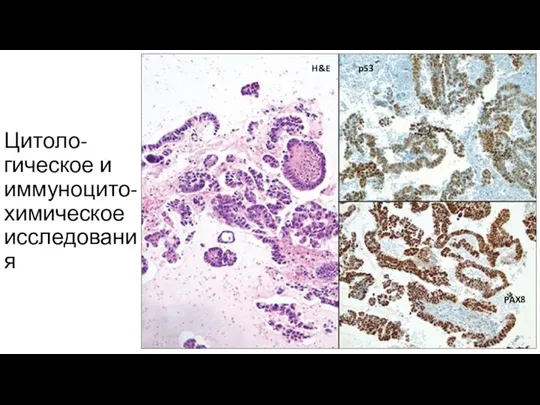 Цитоло-гическое и иммуноцито-химическое исследования H&E p53 PAX8