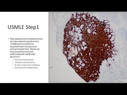 USMLE Step1 При иммуногистохимическом исследовании удаленного лимфоузла выявлена выраженная экспрессия панцитокератина.