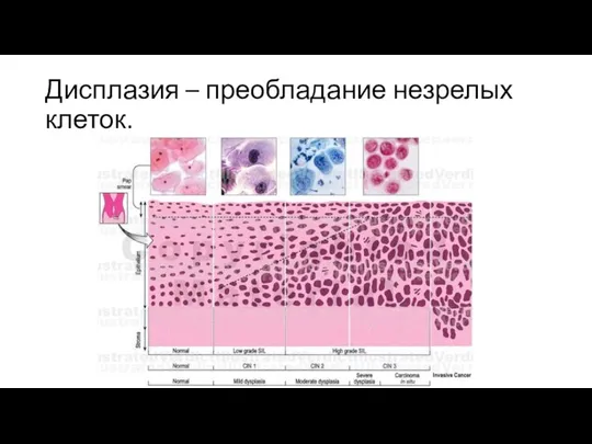 Дисплазия – преобладание незрелых клеток.