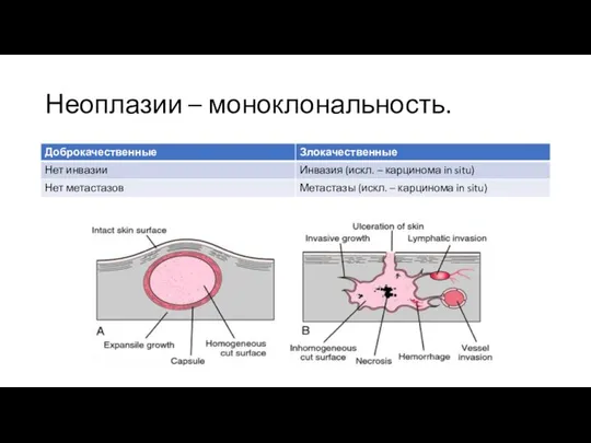 Неоплазии – моноклональность.