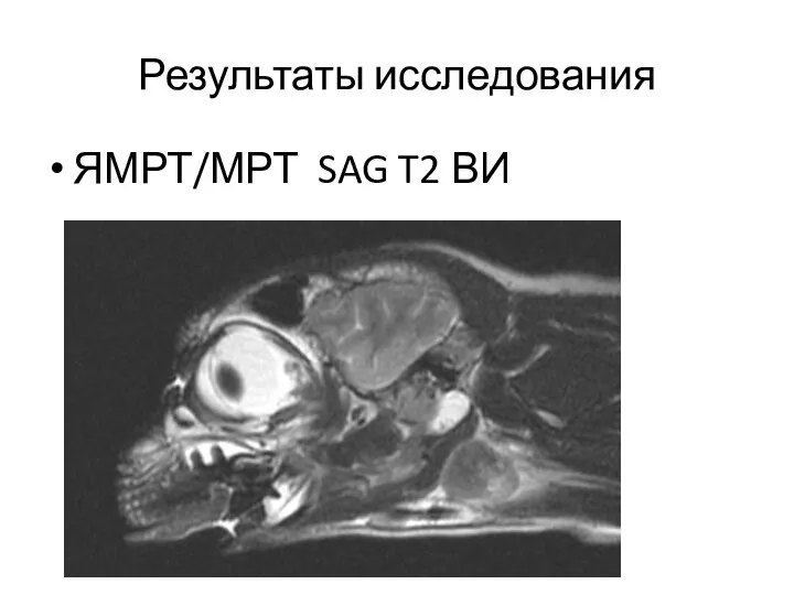 Результаты исследования ЯМРТ/МРТ SAG T2 ВИ