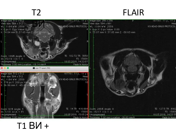 T2 ВИ FLAIR T1 ВИ + contr