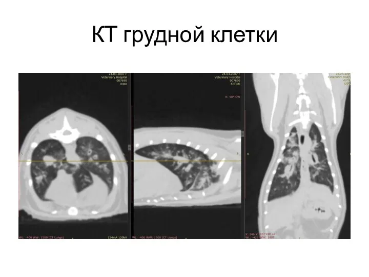 КТ грудной клетки