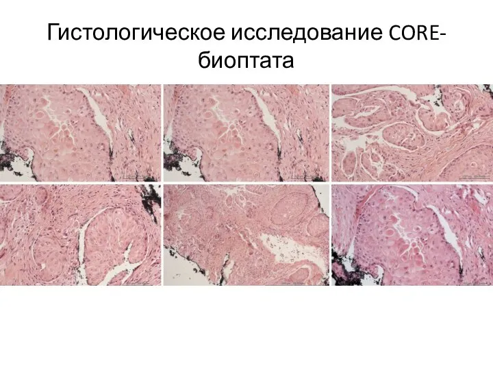 Гистологическое исследование CORE-биоптата CORE-биопсия