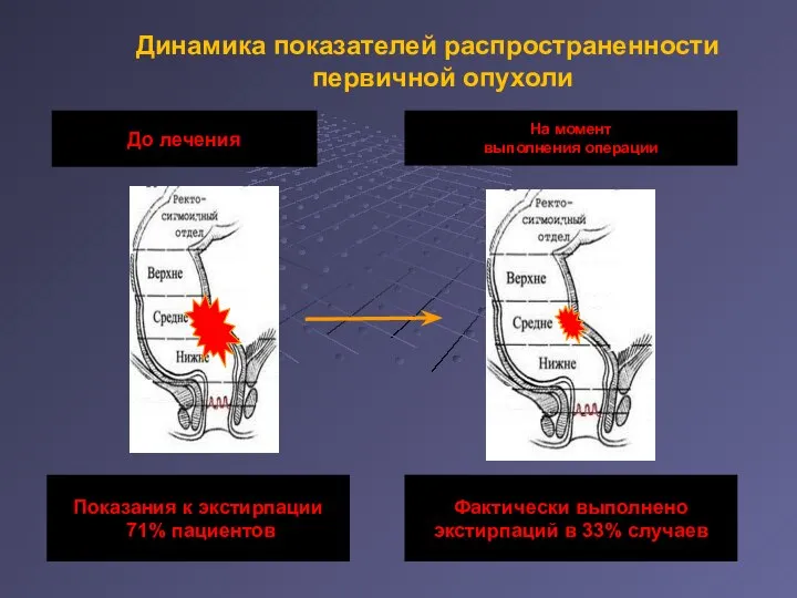 Динамика показателей распространенности первичной опухоли На момент выполнения операции До лечения